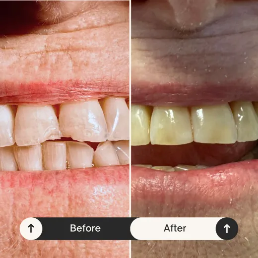 Bioclear black triangle treatment before and after result