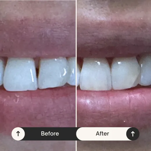 Bioclear composite treatment before and after result